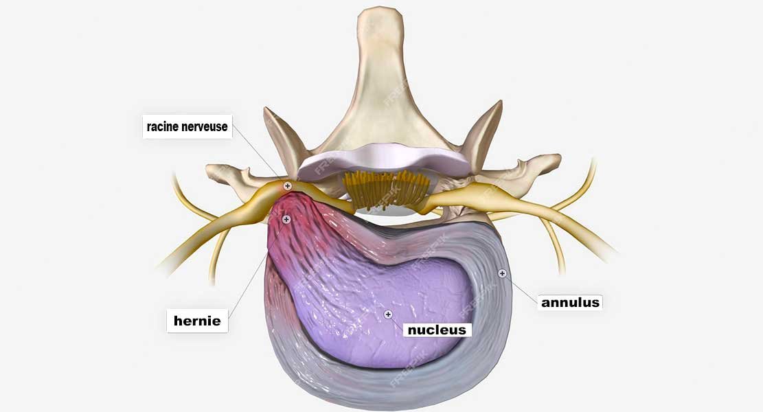 Schema Rachis Attention à la petite barre lombaire ! - Médecine